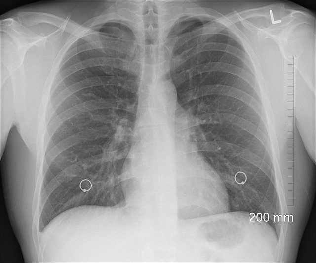 Your lungs are two big, soft, spongy bags that sit inside your chest. They are protected by your ribs, and they sit on both sides of your heart.